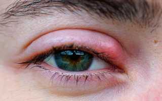 Болезни, из-за которых слезятся и опухают глаза: возможные источники инфекций