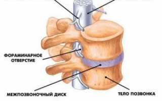 Грыжа пояснично-крестцового отдела позвоночника: симптомы и лечение