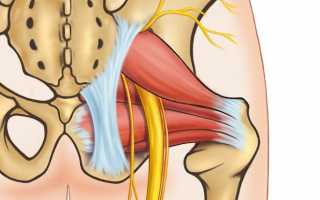 Защемление седалищного нерва: почему происходит? Симптомы, лечение