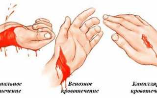 Методы первой помощи при артериальном кровотечении
