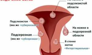 Узнаем причины кровотечений при миоме