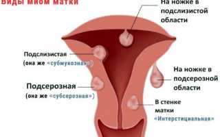 Узнаем причины кровотечений при миоме