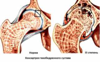 Коксартроз 3 степени: клинические проявления, лечение и профилактика патологии