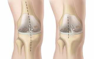 Эндопротезирование коленного сустава: виды, протезы, профилактика