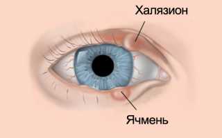 Сразу решиться на операцию – или есть другие способы лечения холязиона на веке?