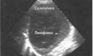 Полная информация про лимфому селезенки