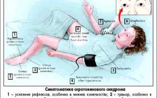 Возникновение серотонинового синдрома и методы его ликвидации