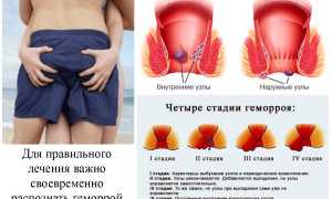 Причины и методы лечения крови из заднего прохода у мужчин