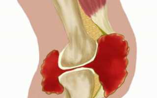 Гемартроз – что это такое? Причины, симптомы, лечение