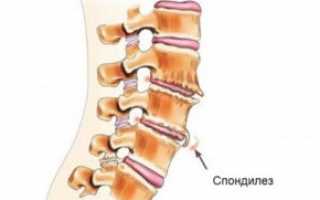 Деформирующий спондилез: что это такое? Причины, симптомы и лечение