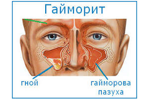 гайморит без прокола