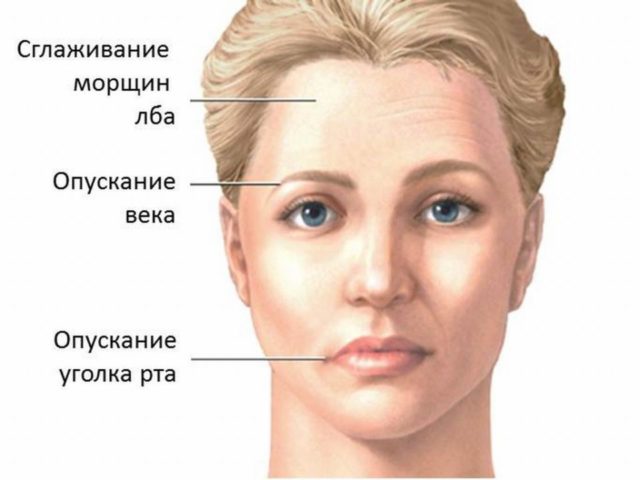 Как проявляется парез