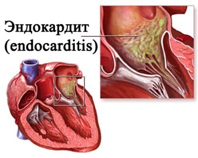 Септический эндокардит