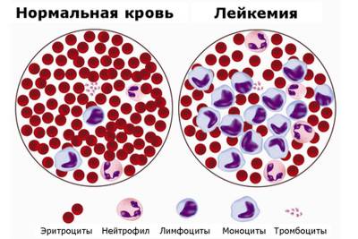 белокровие