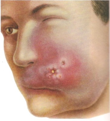 Септикопиемия